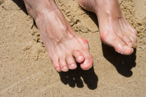 How Hammertoe Occurs