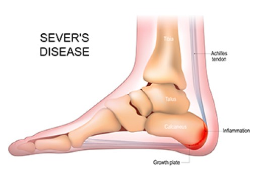 Sever's Disease