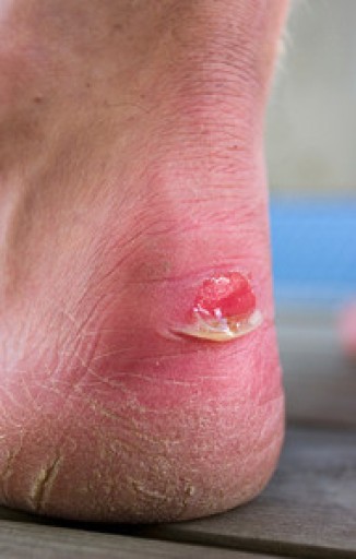 Blisters on the Feet