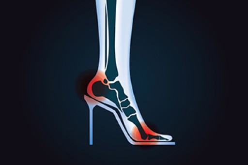 Why High Heels Are Not Ideal for Healthy Feet