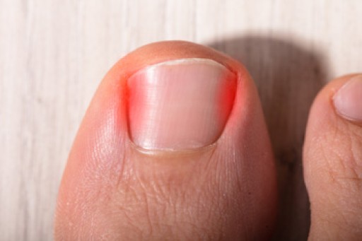 Why Do Ingrown Toenails Develop?