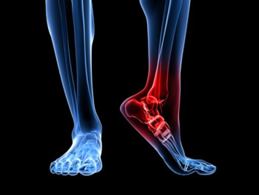 Who Does Sever’s Disease Affect?