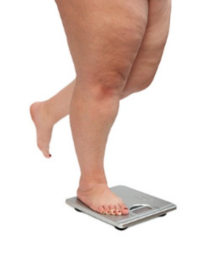 How Obesity Affects Your Feet