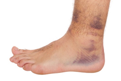 Three Grades of Ankle Sprains